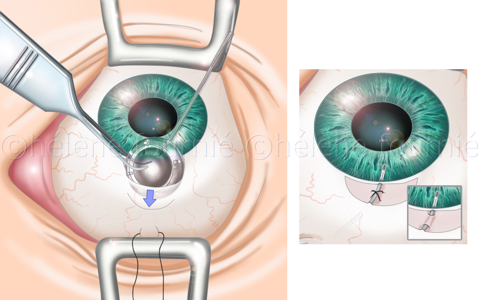 FCI-chirurgie-glaucome