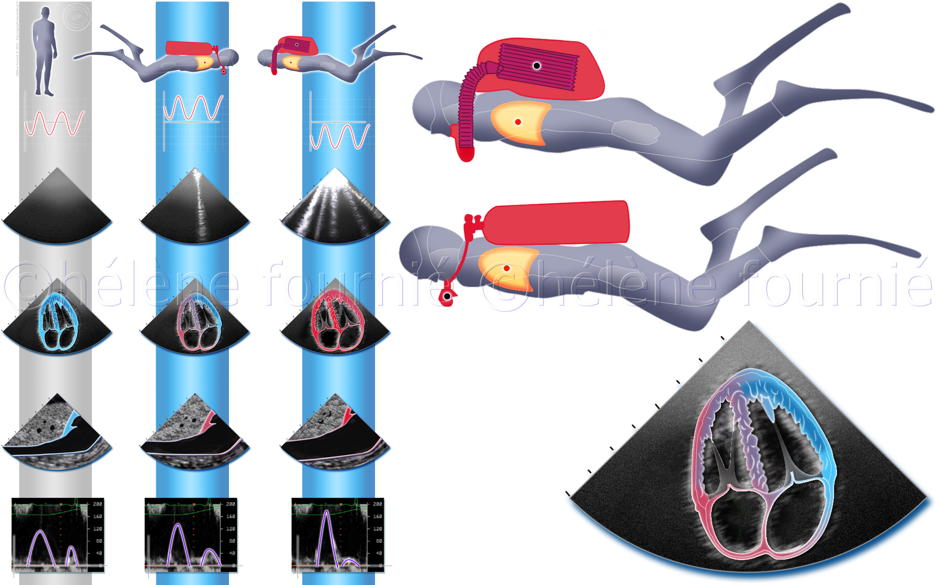 Edema-pulmonary-divers