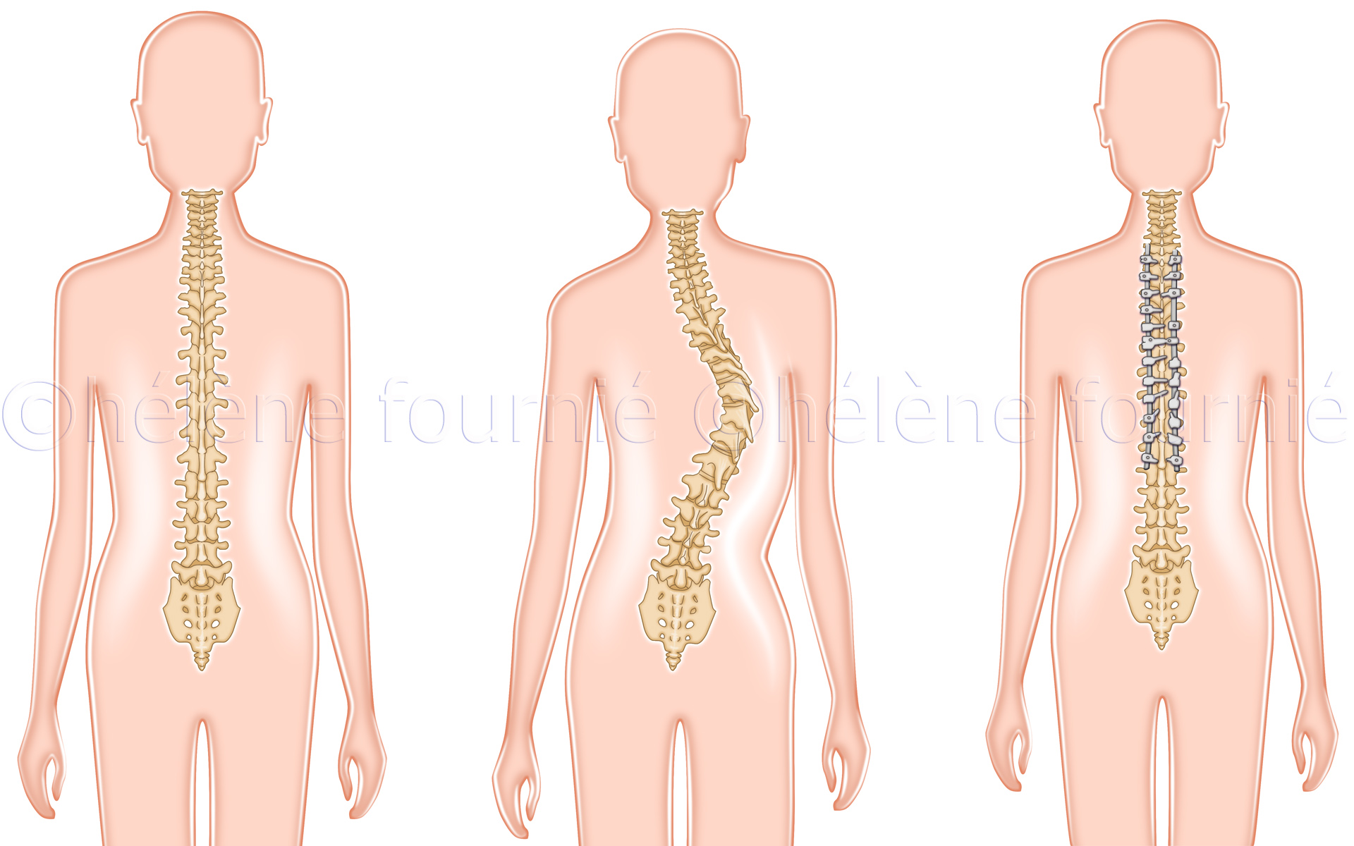 Chirurgie-colonne-scoliose