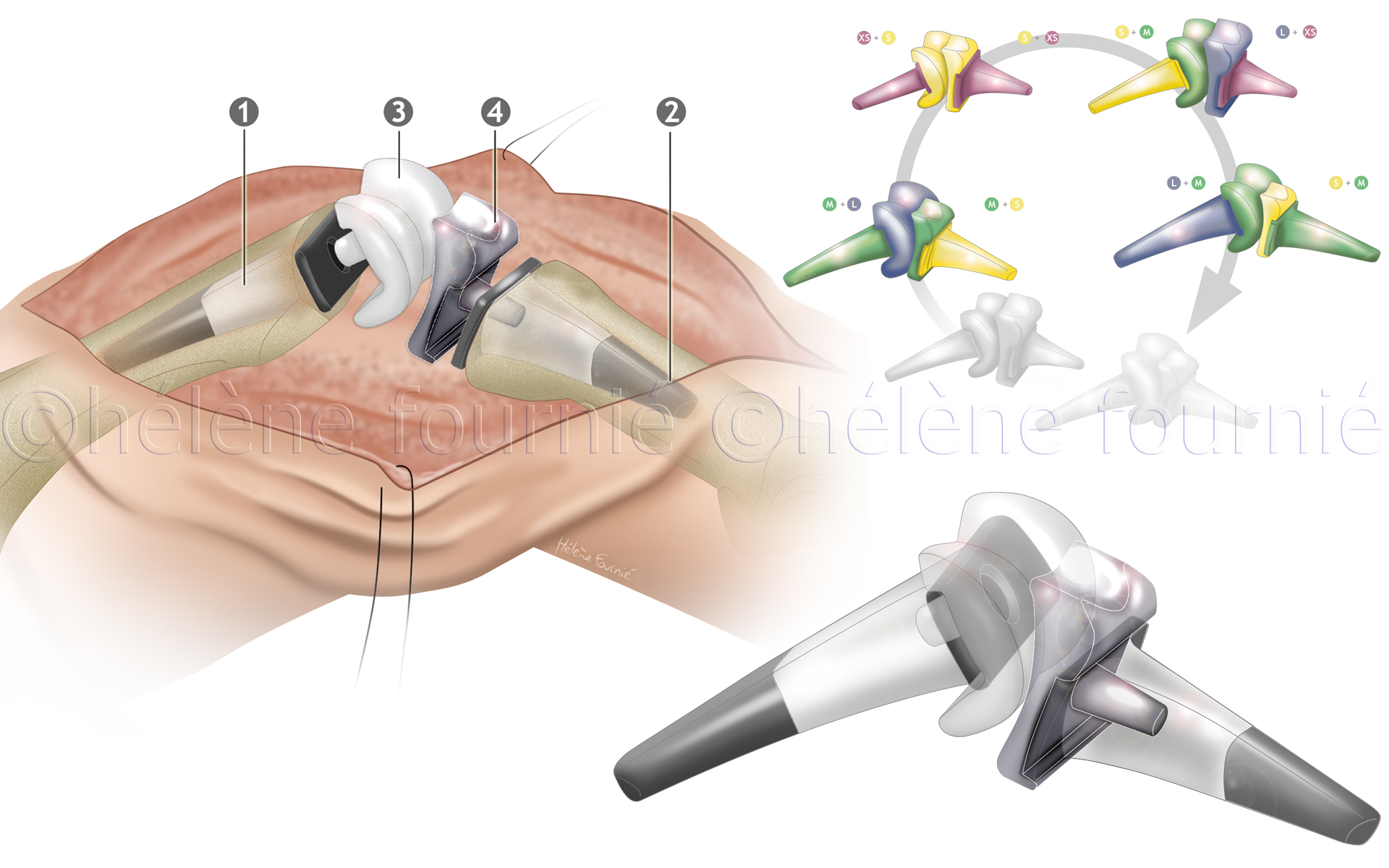 Memometal-hand-surgery