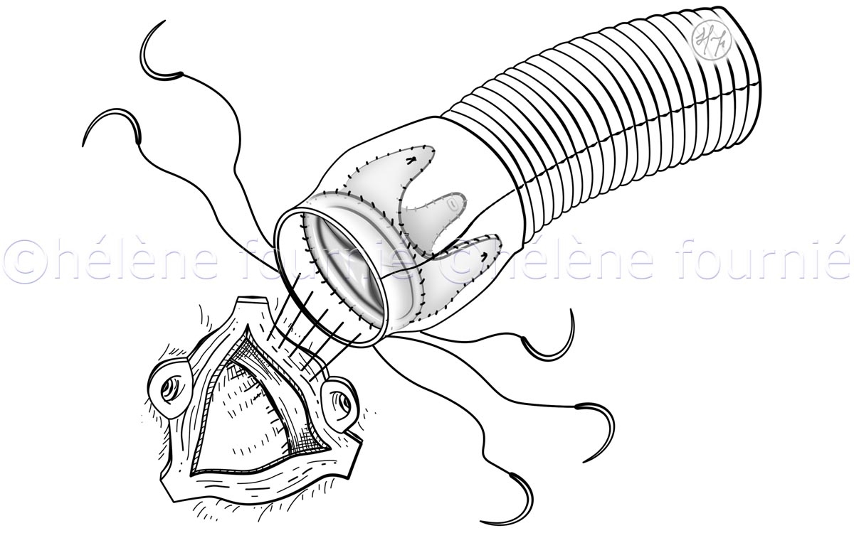 Cardiac-surgery-illustration