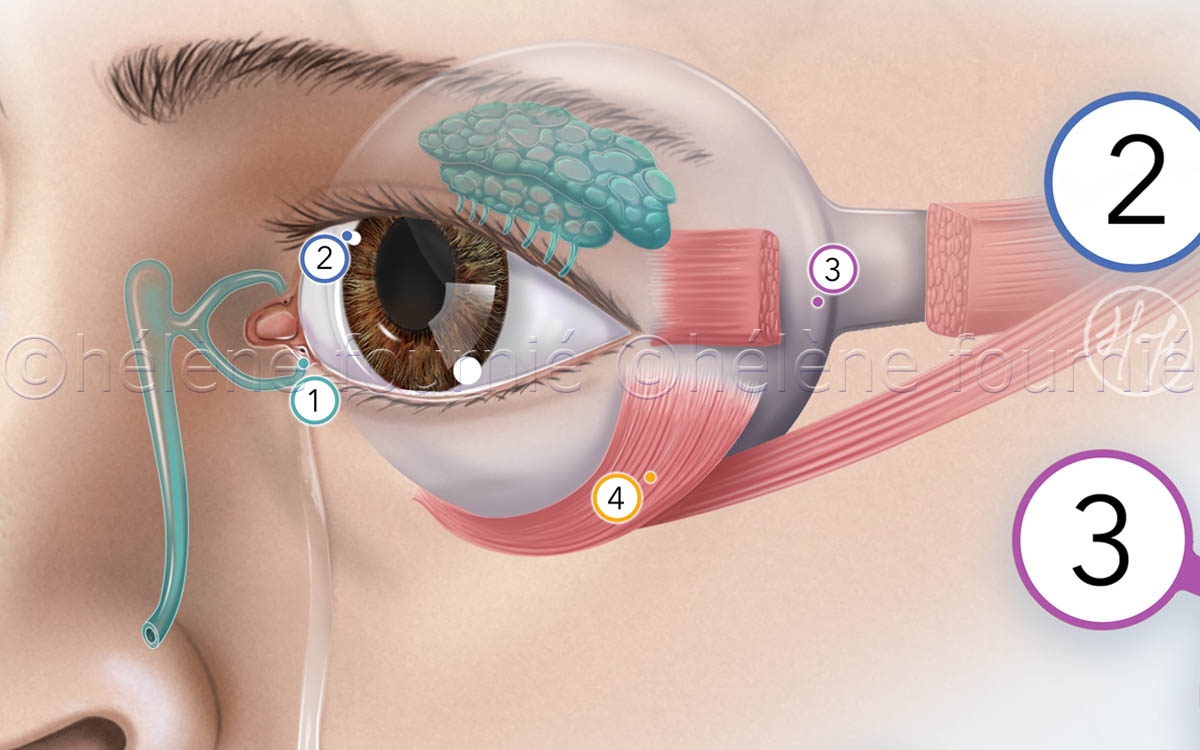 Ophtalmology-charcot's disease