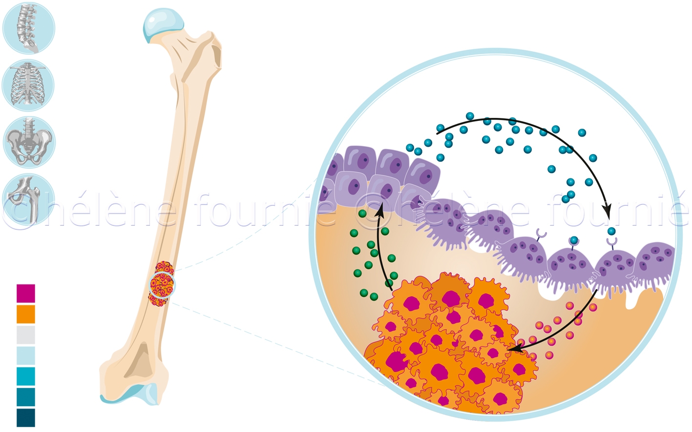 Metastases du cancer du rein