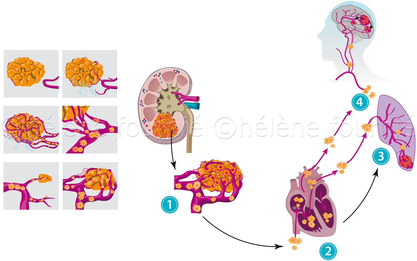 Metastases du cancer du rein