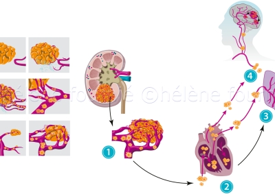Metastases du cancer du rein