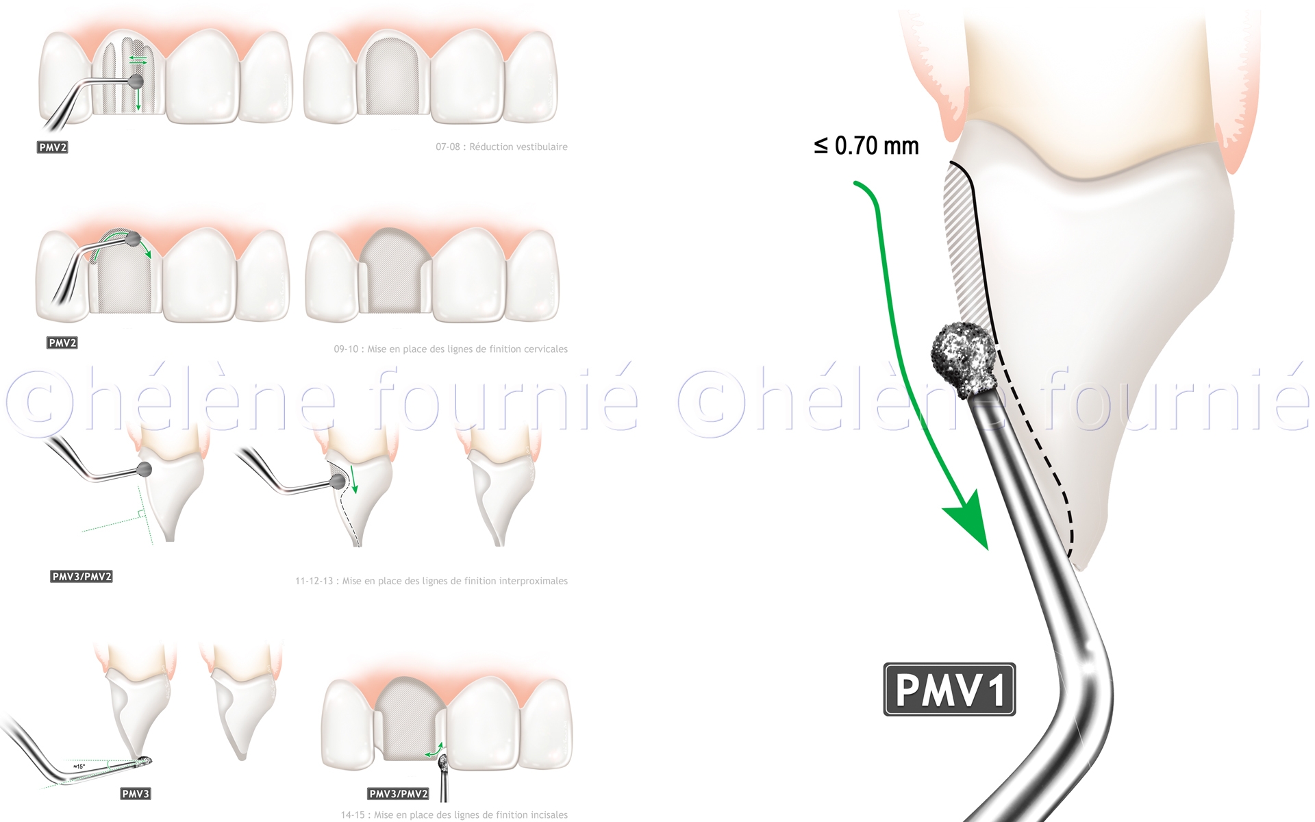  Acteon Inserts-dental-surgery