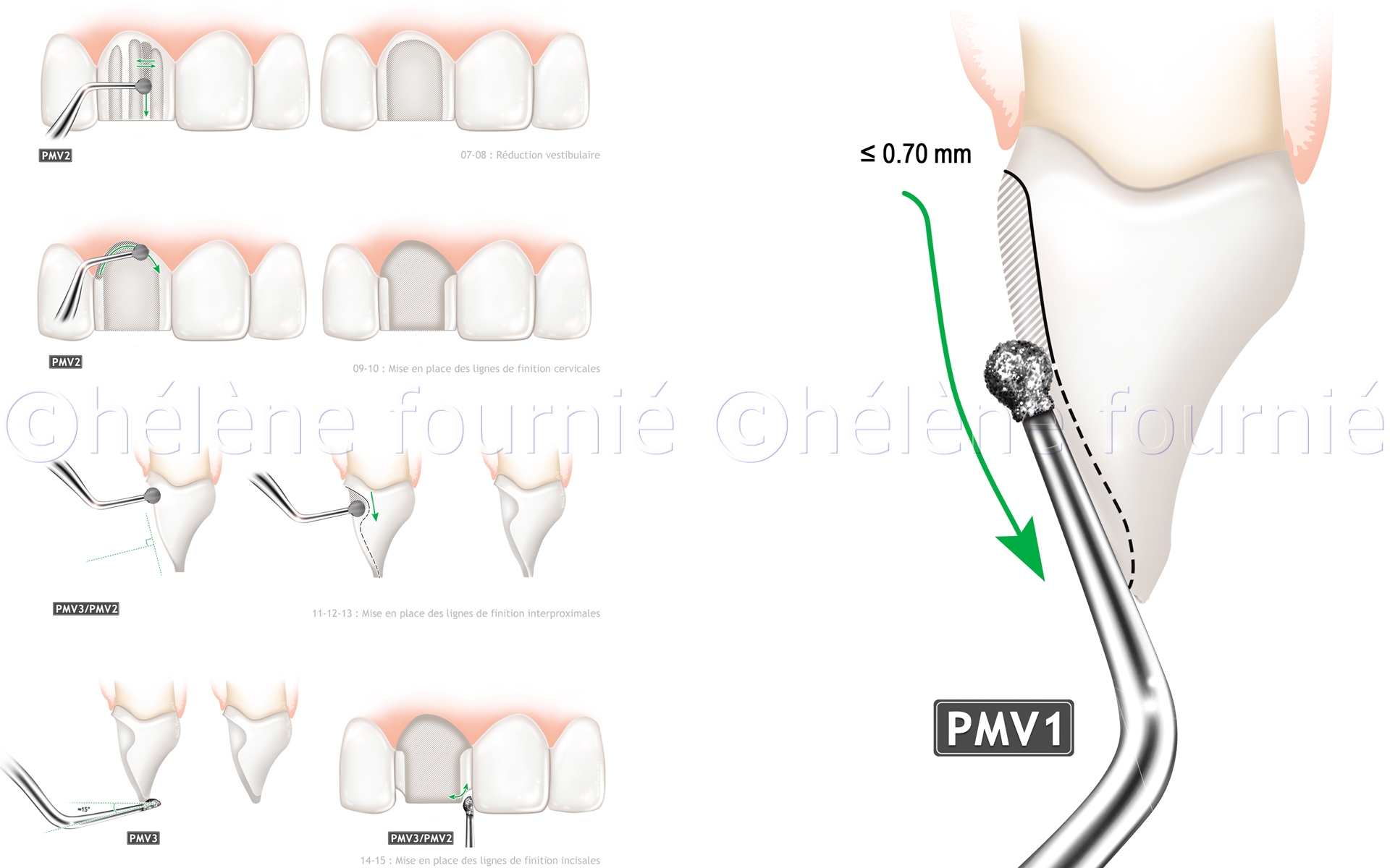 Acteon Inserts-chirurgie-dentaire