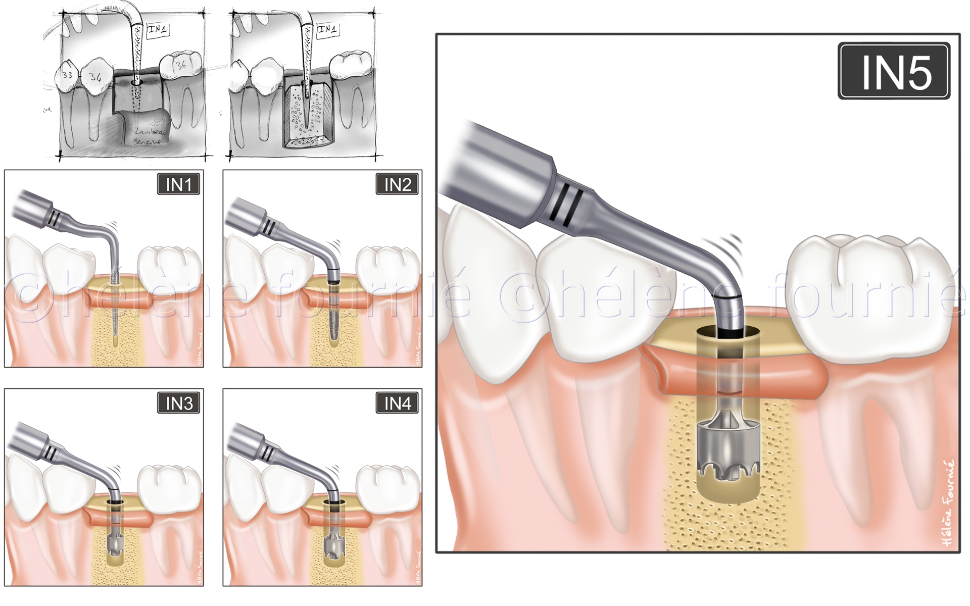 Acteon Inserts-chirurgie-dentaire