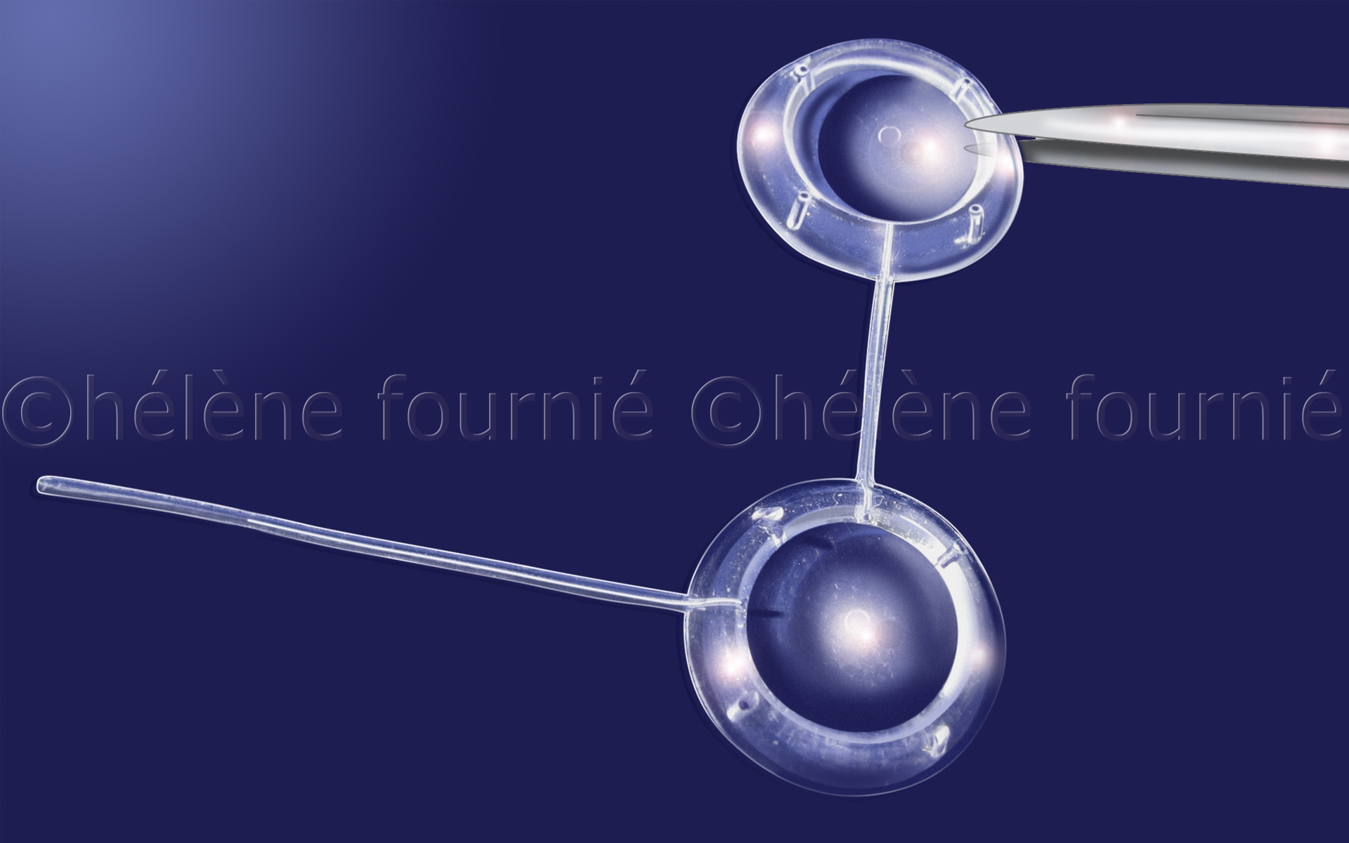 FCI-glaucoma-surgery