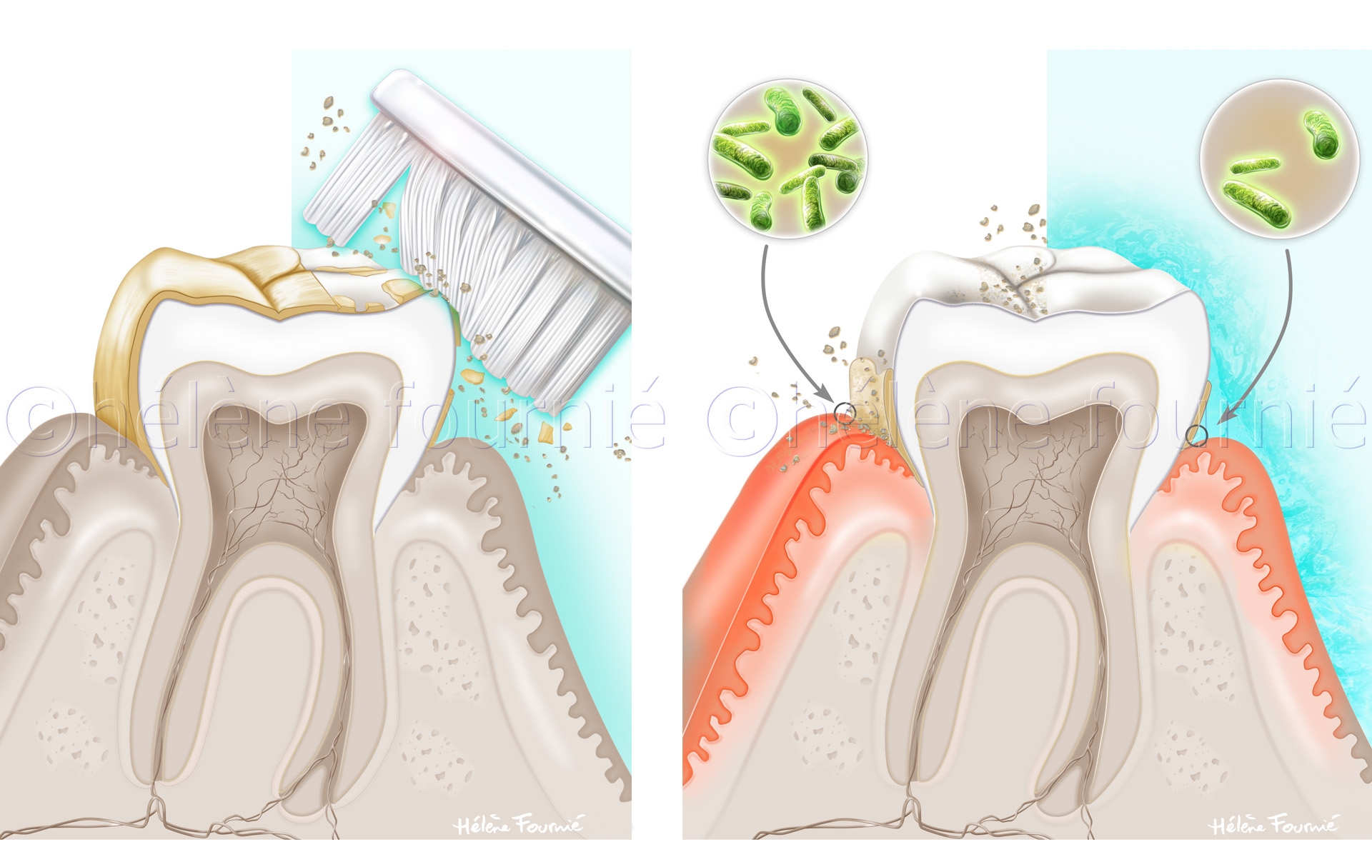 Hextril-dental-treatment