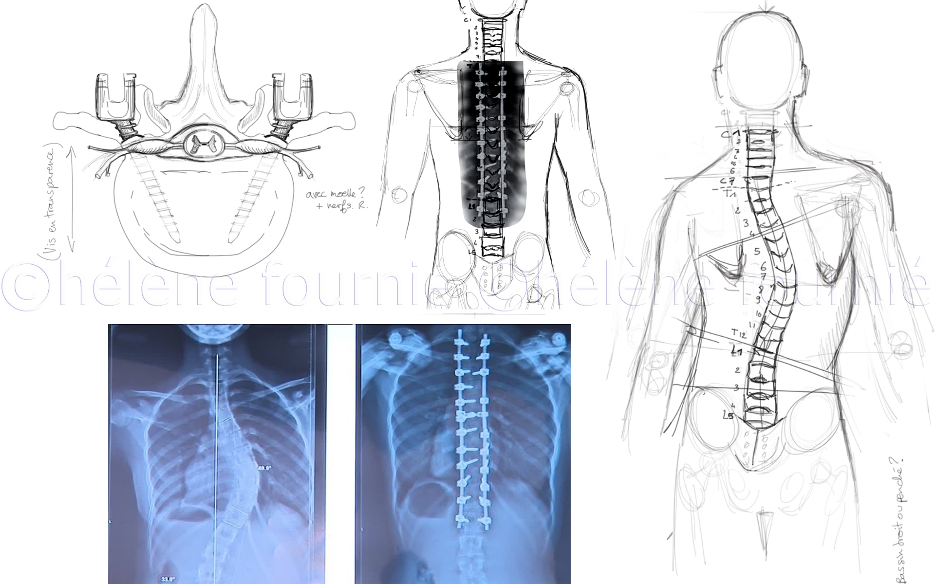 Spinal-surgery-scoliosis