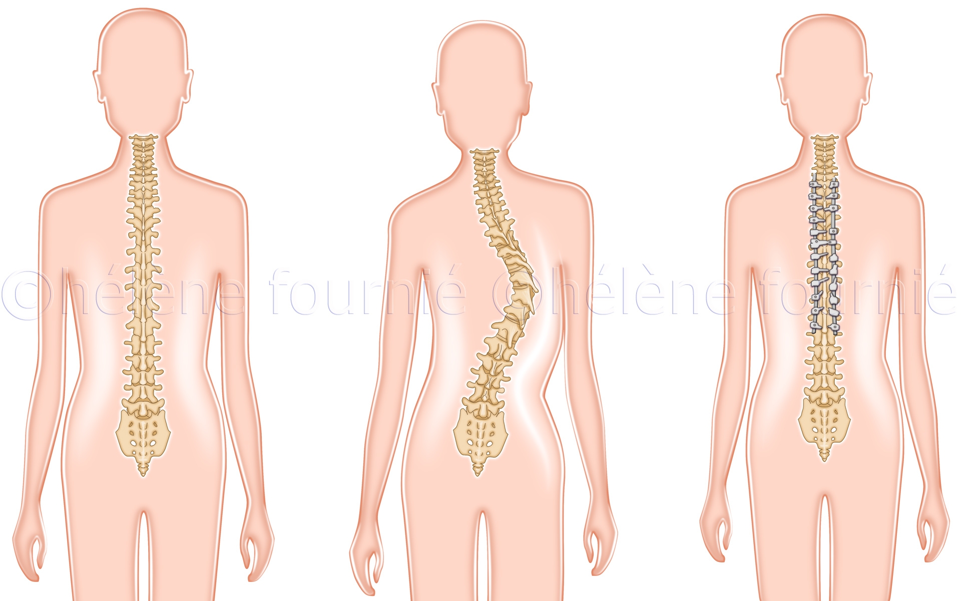 Spinal-surgery-scoliosis