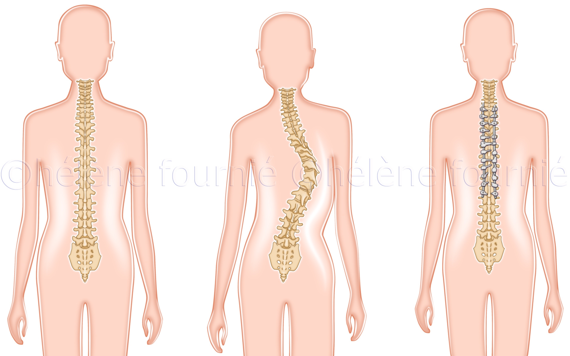 Chirurgie-colonne-scoliose