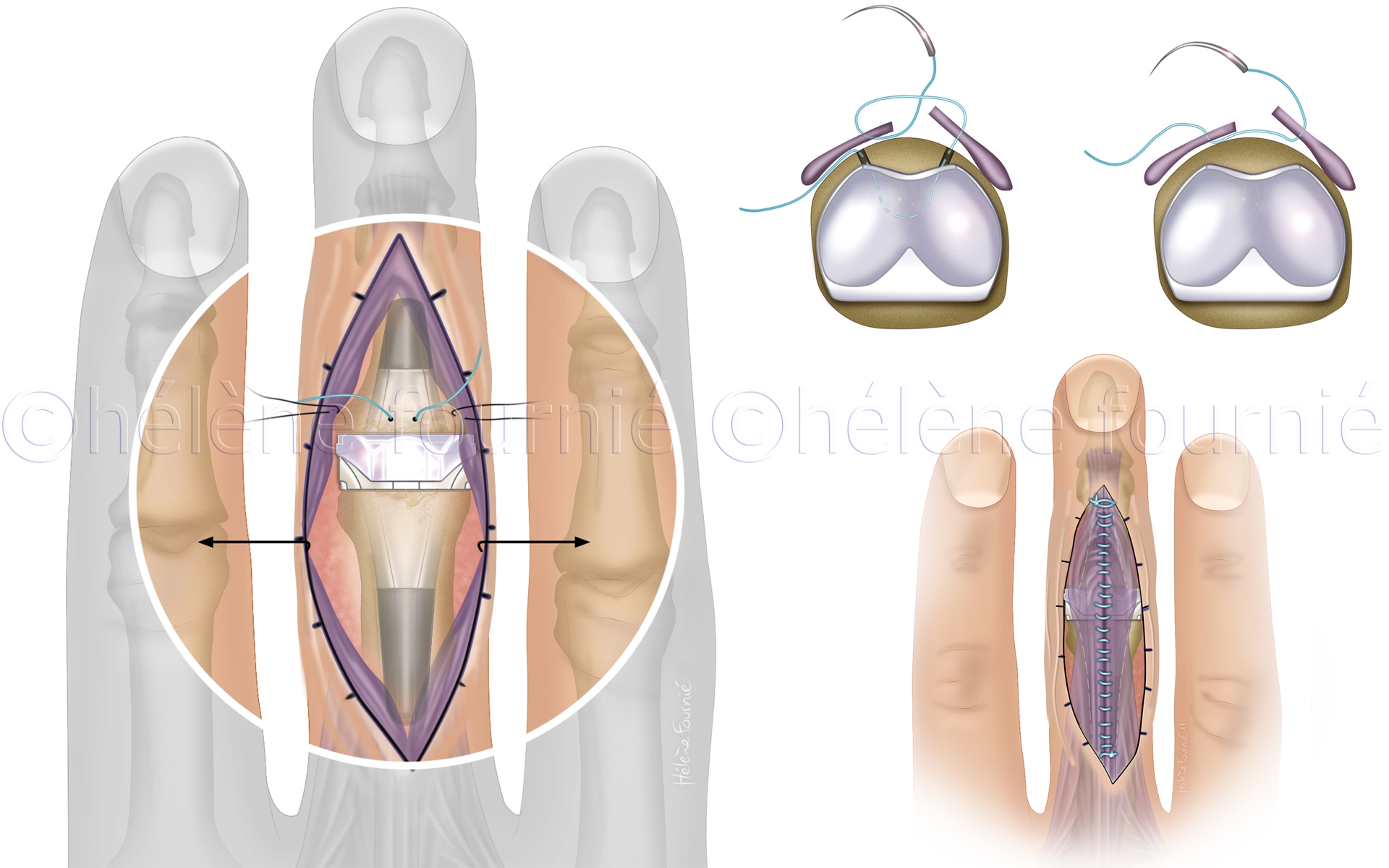 Memometal-hand-surgery