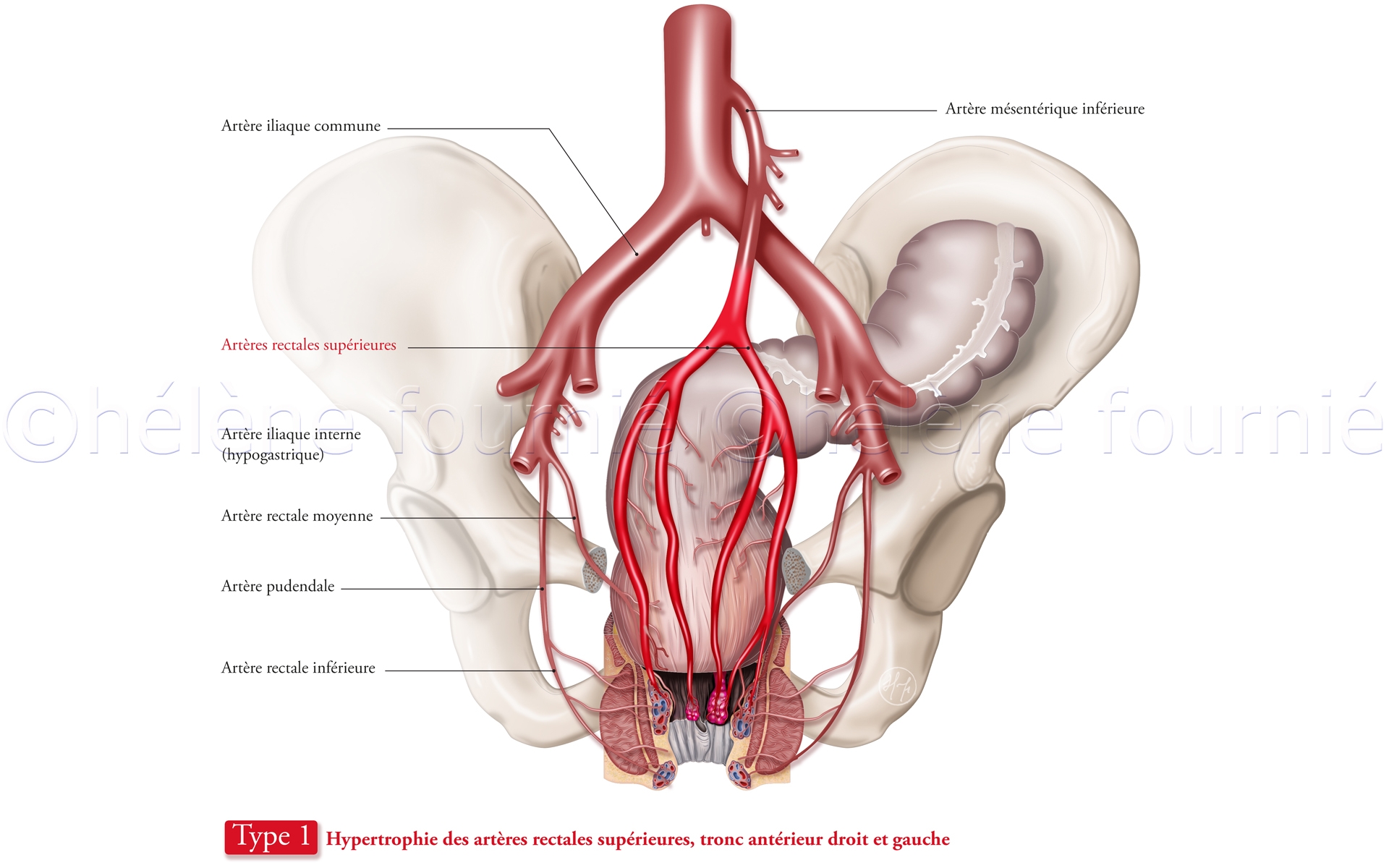 Embolisation-artères-hémorroïdaires-dessins